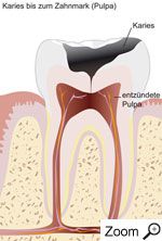 Tief reichende Karies