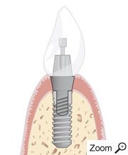 Implantataufbau